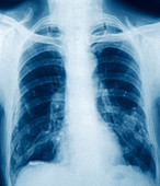 Pleural calcification,X-ray