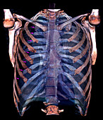 Pneumothorax,3D CT scan