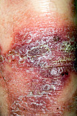 Psoriasis skin disorder