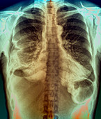 Pleurisy,X-ray