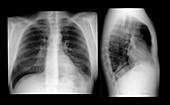 Lung infection,X-ray
