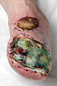 Infected skin graft