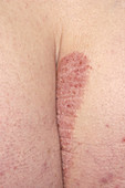 Psoriasis skin disorder