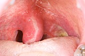 Swollen uvula and sore throat