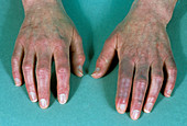 Hands of person with Raynaud's disease