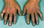 Hands of a Raynaud's disease sufferer