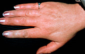 Hand of a Raynaud's syndrome sufferer