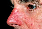 Acne Rosacea affecting a man's nose & cheeks