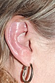 Ramsay Hunt syndrome,inflamed ear