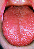 Dry tongue in Sjogren's syndrome