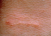 Scabies rash on skin