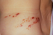 Shingles rash,2 weeks after treatment