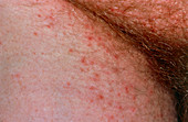 Scabies infection near the groin