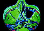 Coloured CT scan showing sinusitis