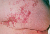 Close up of adult buttock with shingles scars
