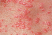 Red papules on the skin due to scabies