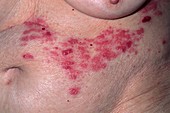 Shingles rash on woman's abdomen