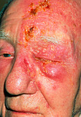 Shingles on head of elderly male,3rd day