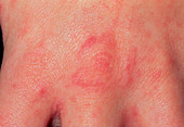 Scabies skin infection on hand knuckles