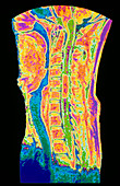 Coloured MRI scan of neck showing syringomyelia
