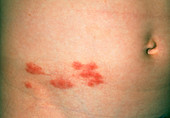 Herpes zoster (shingles) blisters on boy's abdomen
