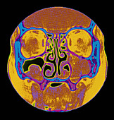 Coloured CT scan of sinusitis and a nasal polyp