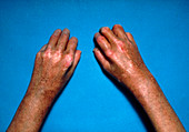 Shiny toughened skin on hands due to scleroderma