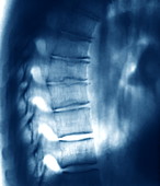 Scheuermann's disease,CT scan