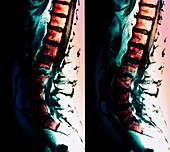 Spondylitis of spine,MRI