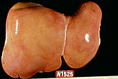 Liver steatosis