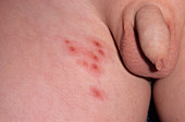 Shingles rash