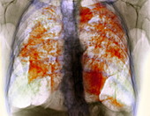 Lung silicosis,X-ray