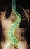 Scoliosis in Sotos syndrome,X-ray
