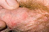 Shingles rash on penis