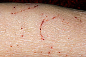 Scabies on arm