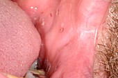 Mouth ulceration due to shingles