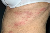 Shingles rash in leukaemia patient