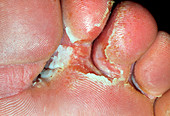 Athlete's foot infection between the toes