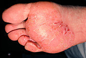 Athlete's foot showing cracked foot