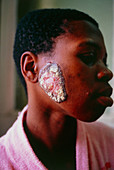 Cutaneous tuberculosis; lesion on woman's cheek