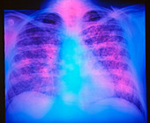 False-colour chest X-ray: miliary tuberculosis