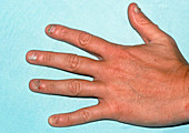 View of hand with fungal nail infection (tinea)