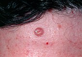 Close-up of trichoepithelioma on human skin