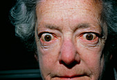 Exophthalmos (bulging eyes) due to thyroid disease