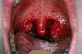 Close-up of throat with tonsillitis