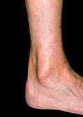 Swollen tendon of patient with achilles tendinitis