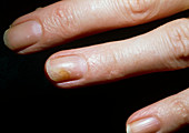 Tinea fungal infection of a woman's fingernail