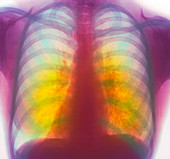 Tuberculosis X-ray