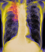 Tuberculosis X-ray