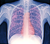 Tuberculosis,X-ray